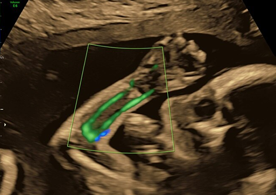 HD-Flow™ in fetal arm using C1-6-D probe